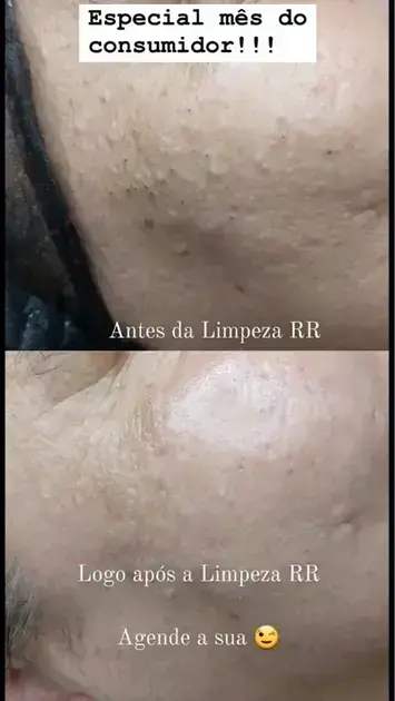curso gratuito de limpeza de pele